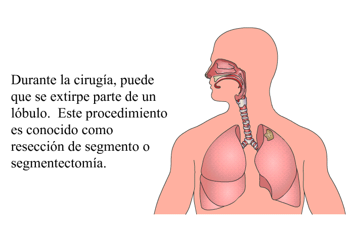 Durante la ciruga, puede que se extirpe parte de un lbulo. Este procedimiento es conocido como reseccin de segmento o <I>segmentectoma</I>.
