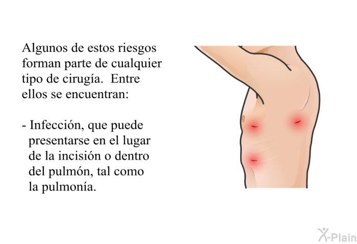 Algunos de estos riesgos forman parte de cualquier tipo de ciruga. Entre ellos se encuentran:  Infeccin, que puede presentarse en el lugar de la incisin o dentro del pulmn, tal como la pulmona.