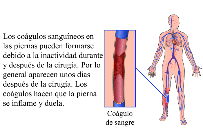 Los cogulos sanguneos en las piernas pueden formarse debido a la inactividad durante y despus de la ciruga. Por lo general aparecen unos das despus de la ciruga. Los cogulos hacen que la pierna se inflame y duela.