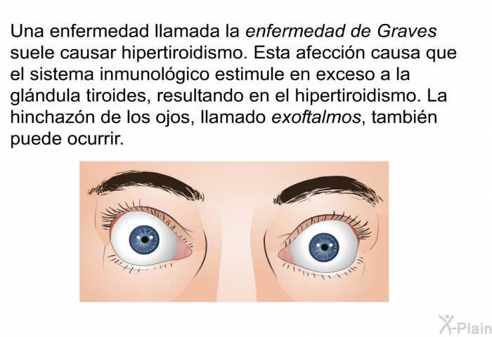 Una enfermedad llamada la <I>enfermedad de Graves</I> suele causar hipertiroidismo. Esta afecci�n causa que el sistema inmunol�gico estimule en exceso a la gl�ndula tiroides, resultando en el hipertiroidismo. La hinchaz�n de los ojos, llamado <I>exoftalmos</I>, tambi�n puede ocurrir.