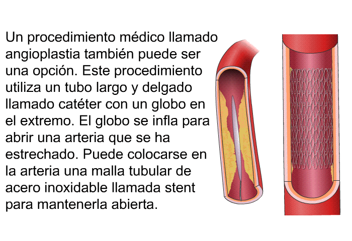 Un procedimiento mdico llamado angioplastia tambin puede ser una opcin. Este procedimiento utiliza un tubo largo y delgado llamado catter con un globo en el extremo. El globo se infla para abrir una arteria que se ha estrechado. Puede colocarse en la arteria una malla tubular de acero inoxidable llamada <I>stent</I> para mantenerla abierta.