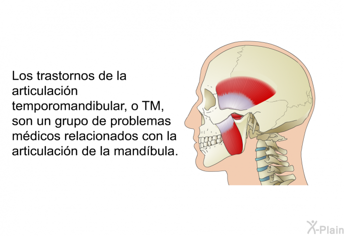Los trastornos de la articulacin temporomandibular, o TM, son un grupo de problemas mdicos relacionados con la articulacin de la mandbula.