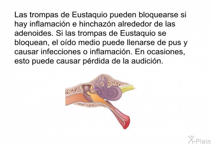 Las trompas de Eustaquio pueden bloquearse si hay inflamacin e hinchazn alrededor de las adenoides. Si las trompas de Eustaquio se bloquean, el odo medio puede llenarse de pus y causar infecciones o inflamacin. En ocasiones, esto puede causar prdida de la audicin.