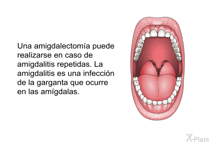 Una amigdalectoma puede realizarse en caso de amigdalitis repetidas. La amigdalitis es una infeccin de la garganta que ocurre en las amgdalas.