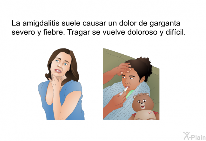 La amigdalitis suele causar un dolor de garganta severo y fiebre. Tragar se vuelve doloroso y difcil.