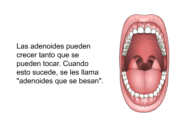 Las adenoides pueden crecer tanto que se pueden tocar. Cuando esto sucede, se les llama <I>“adenoides que se besan”</I>.