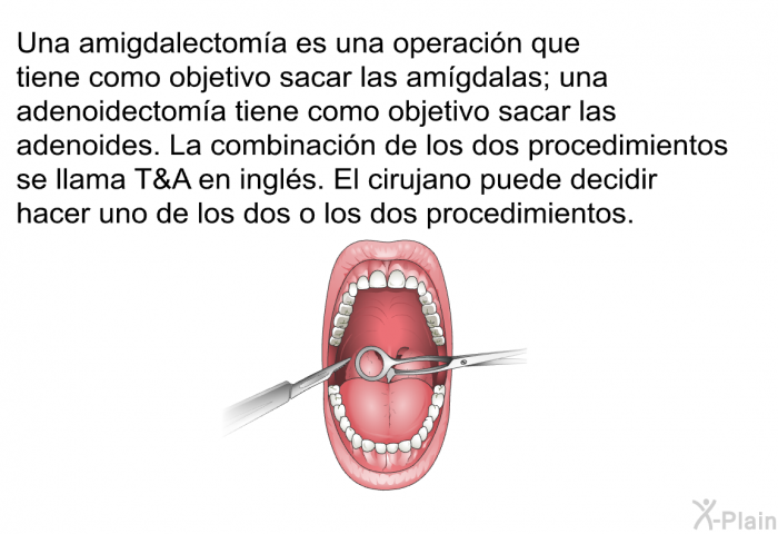 Una amigdalectoma es una operacin que tiene como objetivo sacar las amgdalas; una adenoidectoma tiene como objetivo sacar las adenoides. La combinacin de los dos procedimientos se llama T&A en ingls. El cirujano puede decidir hacer uno de los dos o los dos procedimientos.