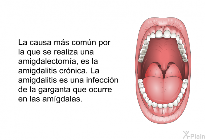 La causa ms comn por la que se realiza una amigdalectoma, es la amigdalitis crnica. La amigdalitis es una infeccin de la garganta que ocurre en las amgdalas.