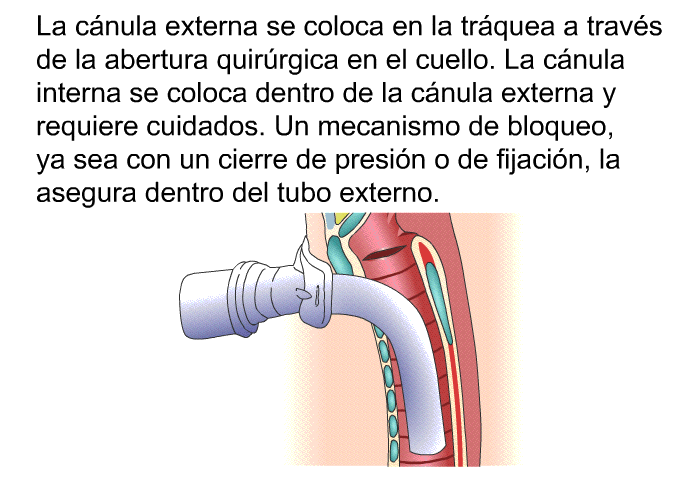 La cnula externa se coloca en la trquea a travs de la abertura quirrgica en el cuello. La cnula interna se coloca dentro de la cnula externa y requiere cuidados. Un mecanismo de bloqueo, ya sea con un cierre de presin o de fijacin, la asegura dentro del tubo externo.