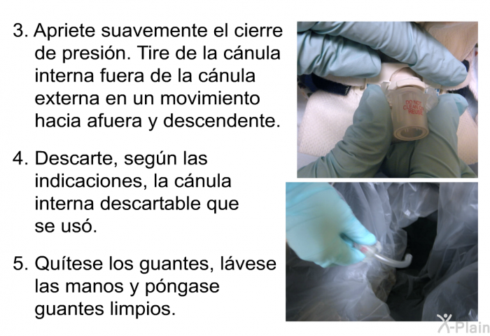 Apriete suavemente el cierre de presi�n. Tire de la c�nula interna fuera de la c�nula externa en un movimiento hacia afuera y descendente. Descarte, seg�n las indicaciones, la c�nula interna descartable que se us�. Qu�tese los guantes, l�vese las manos y p�ngase guantes limpios.