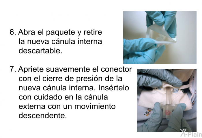 Abra el paquete y retire la nueva c�nula interna descartable. Apriete suavemente el conector con el cierre de presi�n de la nueva c�nula interna. Ins�rtelo con cuidado en la c�nula externa con un movimiento descendente.