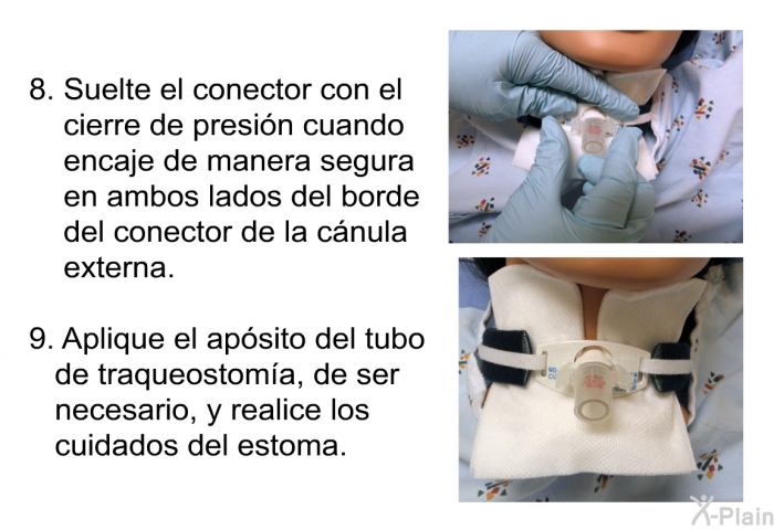 Suelte el conector con el cierre de presi�n cuando encaje de manera segura en ambos lados del borde del conector de la c�nula externa. Aplique el ap�sito del tubo de traqueostom�a, de ser necesario, y realice los cuidados del estoma.