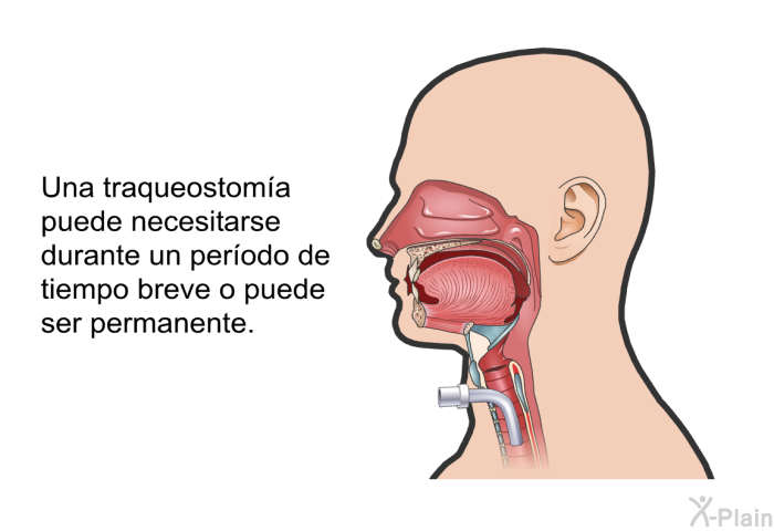 Una traqueostoma puede necesitarse durante un perodo de tiempo breve o puede ser permanente.