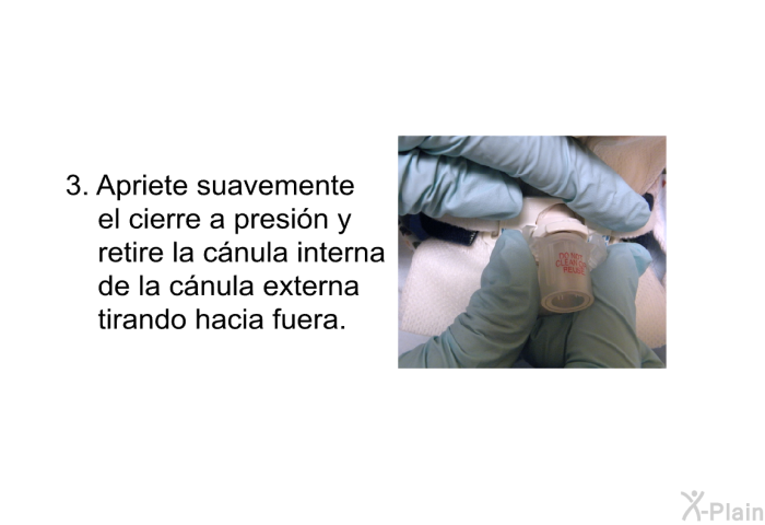 Apriete suavemente el cierre a presi�n y retire la c�nula interna de la c�nula externa tirando hacia fuera.
