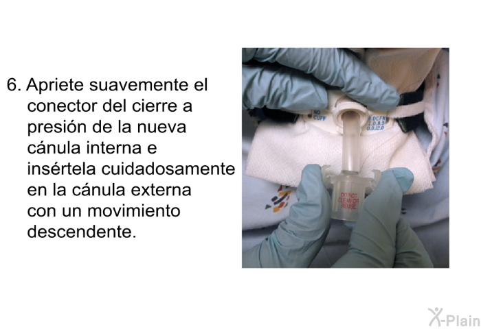 Apriete suavemente el conector del cierre a presi�n de la nueva c�nula interna e ins�rtela cuidadosamente en la c�nula externa con un movimiento descendente.