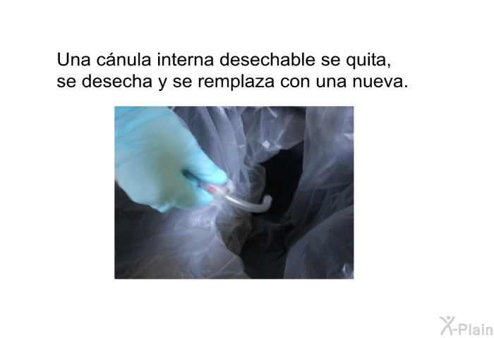 Una c�nula interna desechable se quita, se desecha y se remplaza con una nueva.