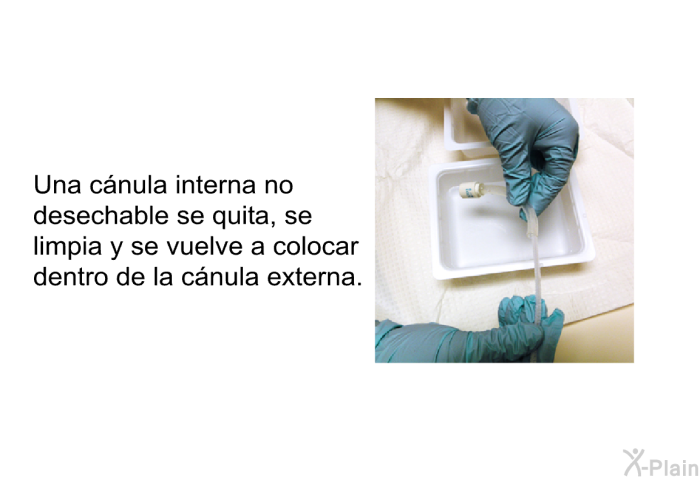 Una c�nula interna no desechable se quita, se limpia y se vuelve a colocar dentro de la c�nula externa.