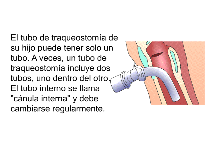 El tubo de traqueostoma de su hijo puede tener solo un tubo. A veces, un tubo de traqueostoma incluye dos tubos, uno dentro del otro. El tubo interno se llama “cnula interna” y debe cambiarse regularmente.