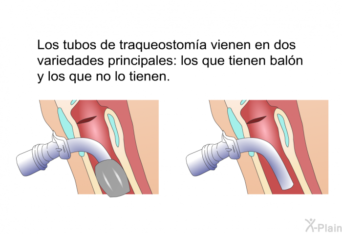 Los tubos de traqueostoma vienen en dos variedades principales: los que tienen baln y los que no lo tienen.