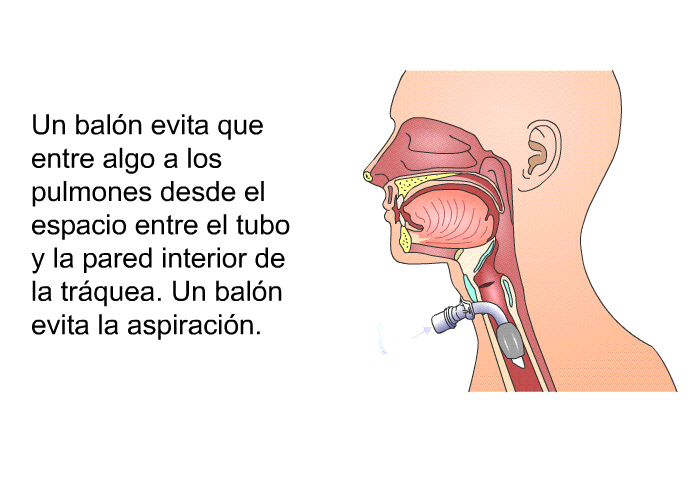 Un baln evita que entre algo a los pulmones desde el espacio entre el tubo y la pared interior de la trquea. Un baln evita la aspiracin.