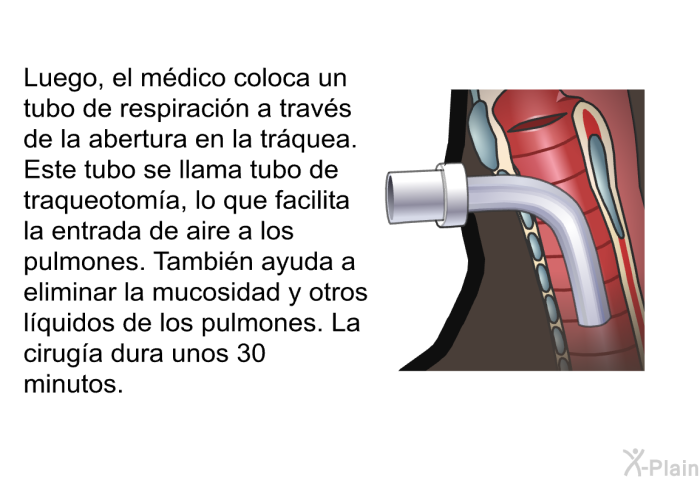 Luego, el mdico coloca un tubo de respiracin a travs de la abertura en la trquea. Este tubo se llama tubo de traqueotoma, lo que facilita la entrada de aire a los pulmones. Tambin ayuda a eliminar la mucosidad y otros lquidos de los pulmones. La ciruga dura unos 30 minutos.