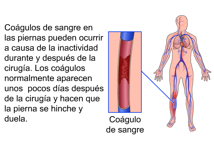 Cogulos de sangre en las piernas pueden ocurrir a causa de la inactividad durante y despus de la ciruga. Los cogulos normalmente aparecen unos pocos das despus de la ciruga y hacen que la pierna se hinche y duela.