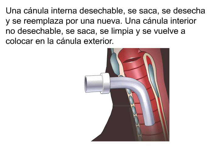 Una cnula interna desechable, se saca, se desecha y se reemplaza por una nueva. Una cnula interior no desechable, se saca, se limpia y se vuelve a colocar en la cnula exterior.