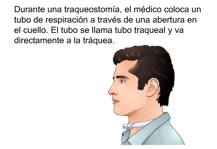 Durante una traqueostoma, el mdico coloca un tubo de respiracin a travs de una abertura en el cuello. El tubo se llama tubo traqueal y va directamente a la trquea.
