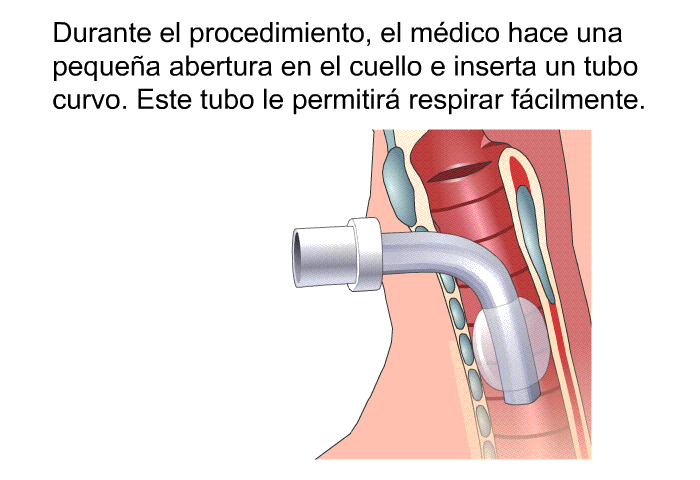 Durante el procedimiento, el mdico hace una pequea abertura en el cuello e inserta un tubo curvo. Este tubo le permitir respirar fcilmente.