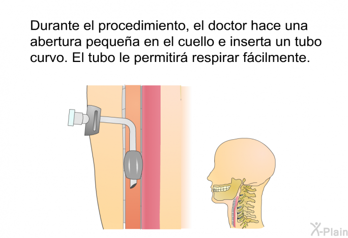 Durante el procedimiento, el doctor hace una abertura peque�a en el cuello e inserta un tubo curvo. El tubo le permitir� respirar f�cilmente.