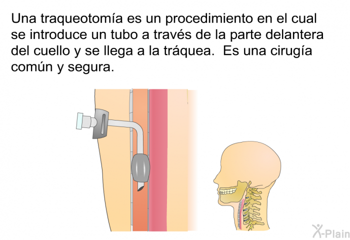Una traqueotoma es un procedimiento en el cual se introduce un tubo a travs de la parte delantera del cuello y se llega a la trquea. Es una ciruga comn y segura.