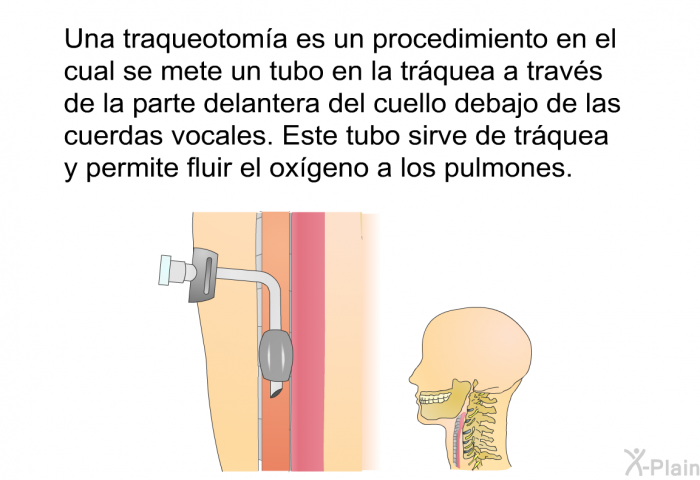 Una traqueotoma es un procedimiento en el cual se mete un tubo en la trquea a travs de la parte delantera del cuello debajo de las cuerdas vocales. Este tubo sirve de trquea y permite fluir el oxgeno a los pulmones.