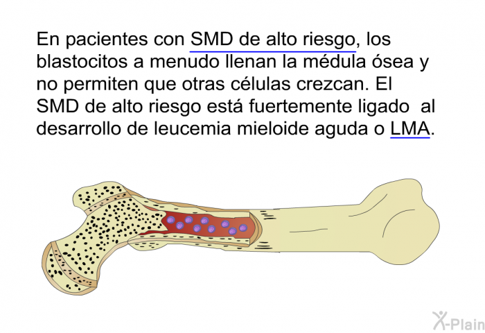 En pacientes con <U>SMD de alto riesgo</U>, los blastocitos a menudo llenan la mdula sea y no permiten que otras clulas crezcan. El SMD de alto riesgo est fuertemente ligado al desarrollo de leucemia mieloide aguda o <U>LMA</U>.