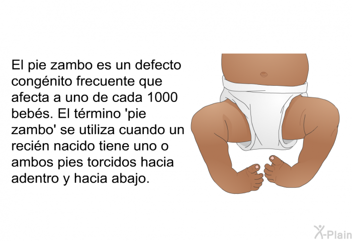 El pie zambo es un defecto congnito frecuente que afecta a uno de cada 1000 bebs. El trmino  pie zambo' se utiliza cuando un recin nacido tiene uno o ambos pies torcidos hacia adentro y hacia abajo.