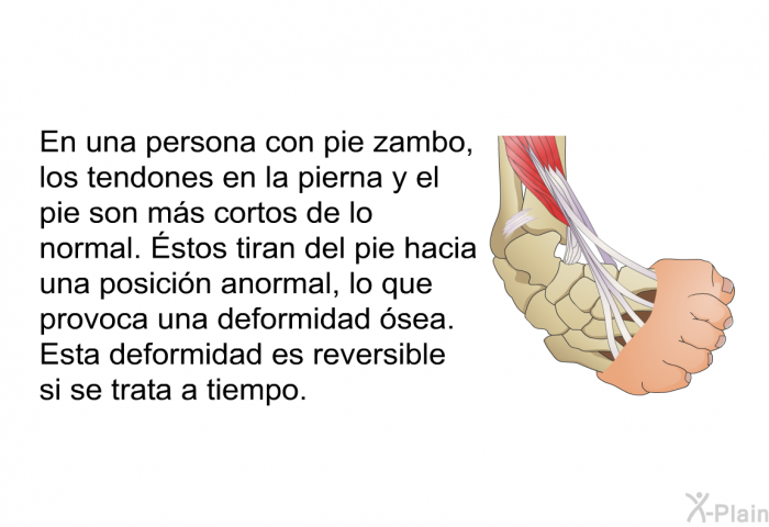 En una persona con pie zambo, los tendones en la pierna y el pie son ms cortos de lo normal. Éstos tiran del pie hacia una posicin anormal, lo que provoca una deformidad sea. Esta deformidad es reversible si se trata a tiempo.