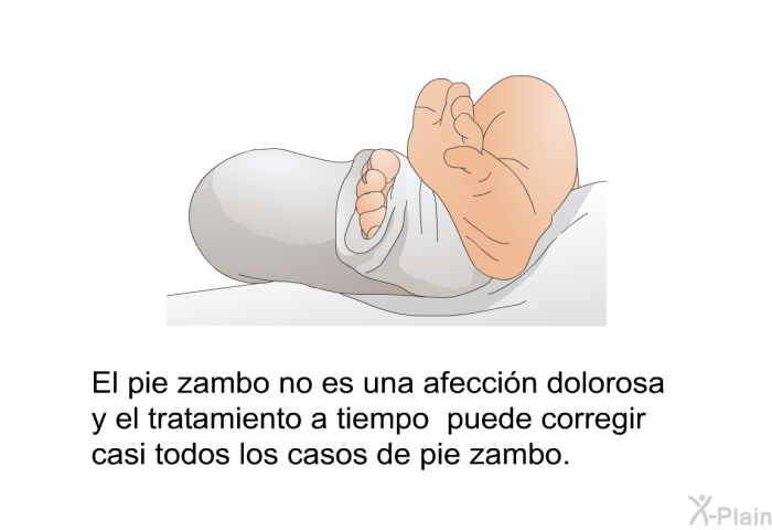 El pie zambo no es una afeccin dolorosa y el tratamiento a tiempo puede corregir casi todos los casos de pie zambo.