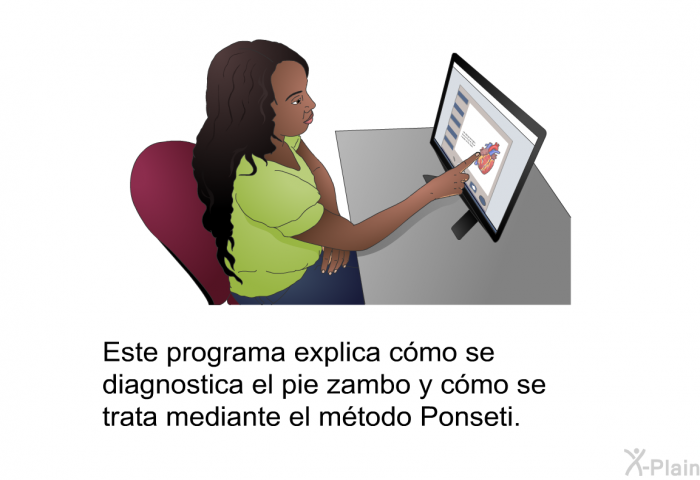 Esta informacin acerca de su salud explica cmo se diagnostica el pie zambo y cmo se trata mediante el mtodo Ponseti.