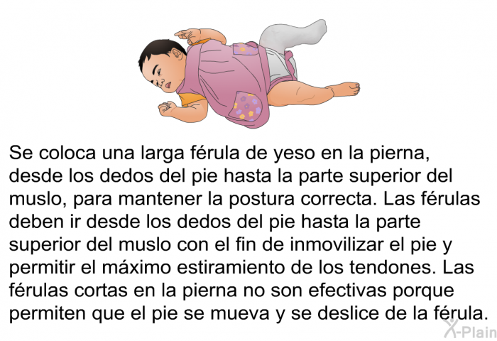 Se coloca una larga frula de yeso en la pierna, desde los dedos del pie hasta la parte superior del muslo, para mantener la postura correcta. Las frulas deben ir desde los dedos del pie hasta la parte superior del muslo con el fin de inmovilizar el pie y permitir el mximo estiramiento de los tendones. Las frulas cortas en la pierna no son efectivas porque permiten que el pie se mueva y se deslice de la frula.