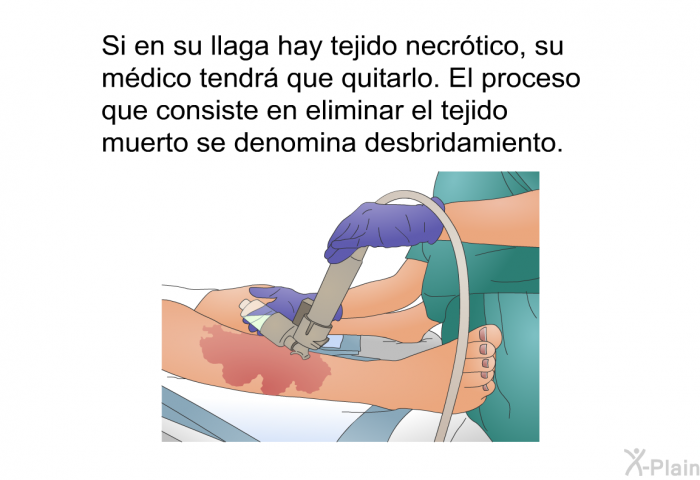 Si en su llaga hay tejido necrtico, su mdico tendr que quitarlo. El proceso que consiste en eliminar el tejido muerto se denomina desbridamiento.