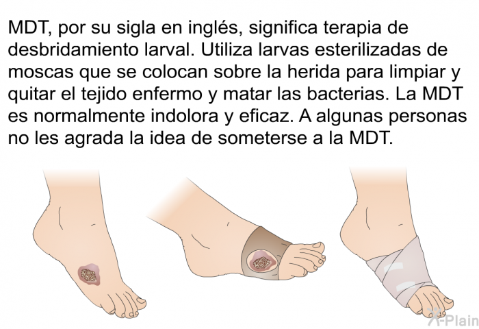 MDT, por su sigla en ingls, significa terapia de desbridamiento larval. Utiliza larvas esterilizadas de moscas que se colocan sobre la herida para limpiar y quitar el tejido enfermo y matar las bacterias. La MDT es normalmente indolora y eficaz. A algunas personas no les agrada la idea de someterse a la MDT.