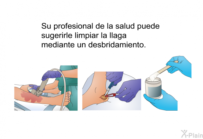 Su profesional de la salud puede sugerirle limpiar la llaga mediante un desbridamiento.