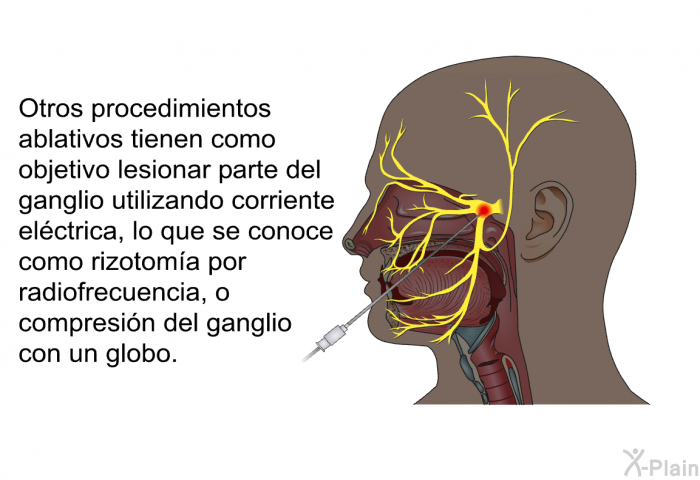 Otros procedimientos ablativos tienen como objetivo lesionar parte del ganglio utilizando corriente elctrica, lo que se conoce como rizotoma por radiofrecuencia, o compresin del ganglio con un globo.