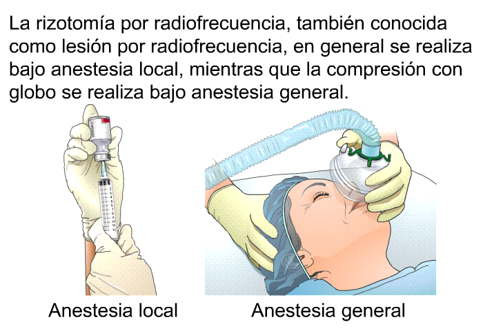 La rizotoma por radiofrecuencia, tambin conocida como lesin por radiofrecuencia, en general se realiza bajo anestesia local, mientras que la compresin con globo se realiza bajo anestesia general.