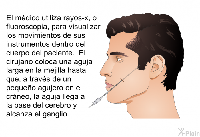El mdico utiliza rayos-x, o fluoroscopia, para visualizar los movimientos de sus instrumentos dentro del cuerpo del paciente. El cirujano coloca una aguja larga en la mejilla hasta que, a travs de un pequeo agujero en el crneo, la aguja llega a la base del cerebro y alcanza el ganglio.