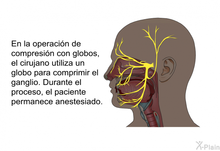 En la operacin de compresin con globos, el cirujano utiliza un globo para comprimir el ganglio. Durante el proceso, el paciente permanece anestesiado.