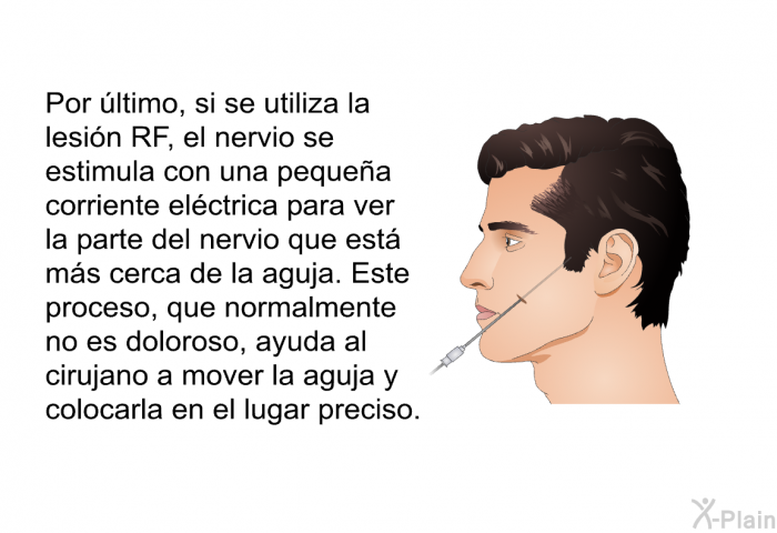 Por ltimo, si se utiliza la lesin RF, el nervio se estimula con una pequea corriente elctrica para ver la parte del nervio que est ms cerca de la aguja. Este proceso, que normalmente no es doloroso, ayuda al cirujano a mover la aguja y colocarla en el lugar preciso.