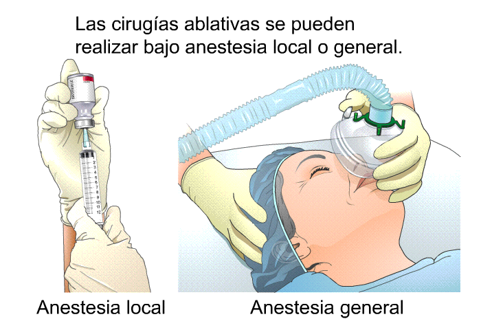 Las cirugas ablativas se pueden realizar bajo anestesia local o general.