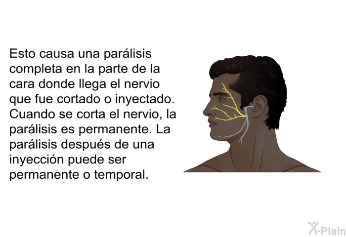 Esto causa una parlisis completa en la parte de la cara donde llega el nervio que fue cortado o inyectado. Cuando se corta el nervio, la parlisis es permanente. La parlisis despus de una inyeccin puede ser permanente o temporal.