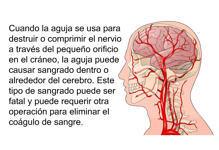 Cuando la aguja se usa para destruir o comprimir el nervio a travs del pequeo orificio en el crneo, la aguja puede causar sangrado dentro o alrededor del cerebro. Este tipo de sangrado puede ser fatal y puede requerir otra operacin para eliminar el cogulo de sangre.