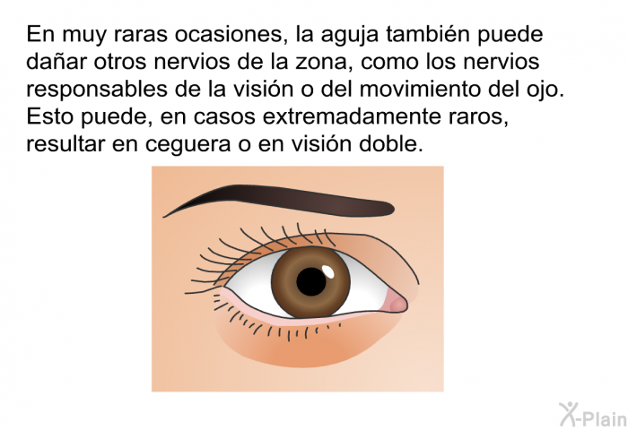 En muy raras ocasiones, la aguja tambin puede daar otros nervios de la zona, como los nervios responsables de la visin o del movimiento del ojo. Esto puede, en casos extremadamente raros, resultar en ceguera o en visin doble.